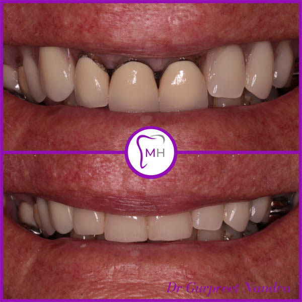 Dental Crowns Before & After 1 - Malvern