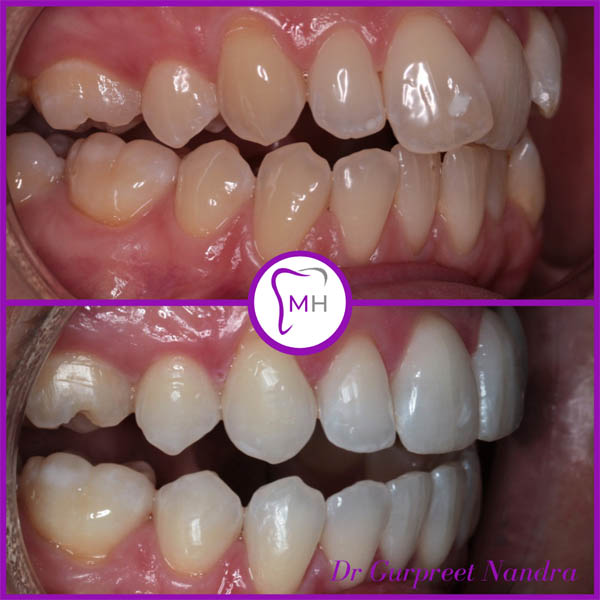 Invisalign & Whitening Before & After Malvern 1