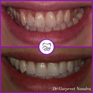 Invisalign & Whitening before and after 1